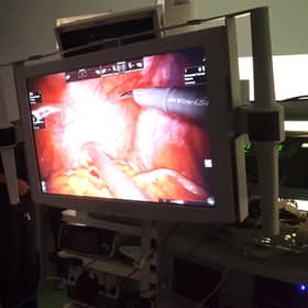 A patient undergoing robot-assisted surgery to remove the prostate in the ProMOTE study. Photo: Professor Alastair Lamb/University of Oxford/PA Wire
