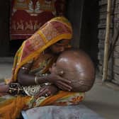 Fatima Khatun 25,  kisses the head of her 18-month-old daughter, Roona, who is suffering from hydrocephalus, in their home in Jirania, a village near Agartala, India (Picture: Arindam Dey/AFP via Getty Images)
