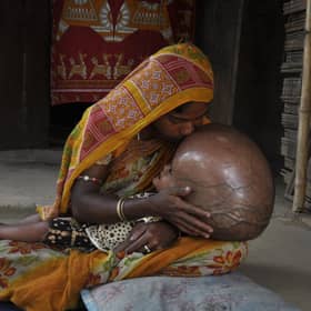 Fatima Khatun 25,  kisses the head of her 18-month-old daughter, Roona, who is suffering from hydrocephalus, in their home in Jirania, a village near Agartala, India (Picture: Arindam Dey/AFP via Getty Images)