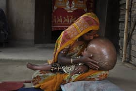 Fatima Khatun 25,  kisses the head of her 18-month-old daughter, Roona, who is suffering from hydrocephalus, in their home in Jirania, a village near Agartala, India (Picture: Arindam Dey/AFP via Getty Images)