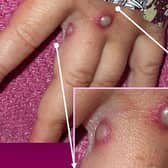 In this Centers for Disease Control and Prevention handout graphic, from 2003, symptoms of one of the first known cases of the monkeypox virus are shown on a patient?s hand May 27, 2003. Photo Courtesy of CDC/Getty Images