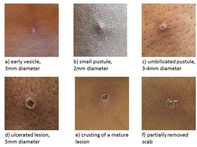Close contacts of the latest cases of monkeypox are being contacted and offered information and health advice "as a precautionary measure", the UKHSA said. Photo: UK Health Security Agency/PA Wire.