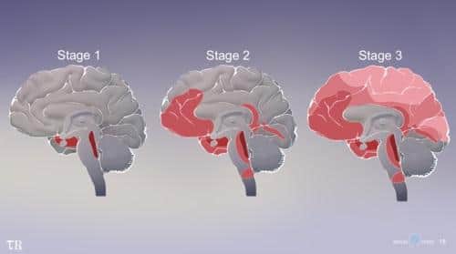 As the world’s population ages, the prevalence of Alzheimer's disease is predicted to reach epidemic proportions