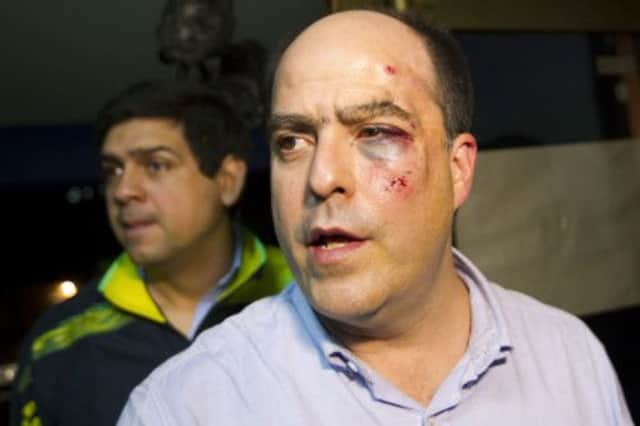 Venezuelan opposition party member Julio Borges arrives at a news conference with a bruised face and a black eye. Picture: Reuters
