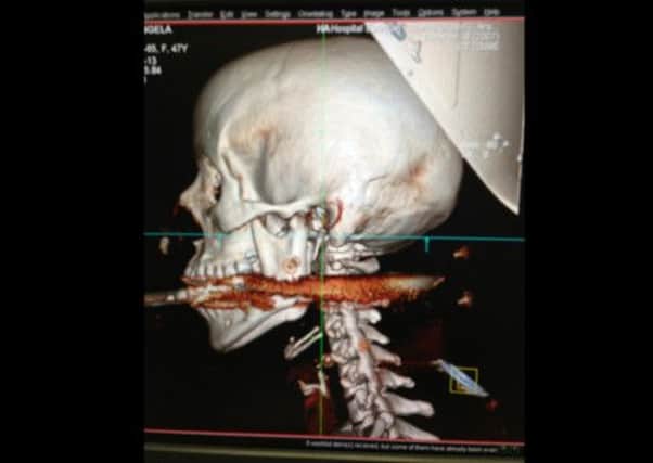 Rio de Janeiro health authorities released a picture showing the spear that was accidentally shot through the mouth of Elisangela Borborema Rosa. Picture: AP