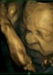 BEST QUALITY AVAILABLE: Undated handout photo issued by Durham University  of a 4D scan of 27 week old fetus showing a "pain" face as unborn babies "practise" facial expressions of pain while they are in the womb, scientists say. PRESS ASSOCIATION Photo. Issue date: Thursday June 6, 2013. Foetuses have been pictured using 4D scanning technology showing what appears to be pain. The researchers, from Durham and Lancaster universities, suggest the ability to grimace is a "developmental process" which could help doctors assess the health of a foetus. The study, published in the journal Plos One, found when the mother was 24 weeks' pregnant, unborn babies were able to make simple expressions such as smiling. See PA story HEALTH Expressions. Photo credit should read: Durham University/PA Wire NOTE TO EDITORS: This handout photo may only be used in for editorial reporting purposes for the contemporaneous illustration of events, things or the people in the image or facts mentioned in the caption. Reuse of the picture