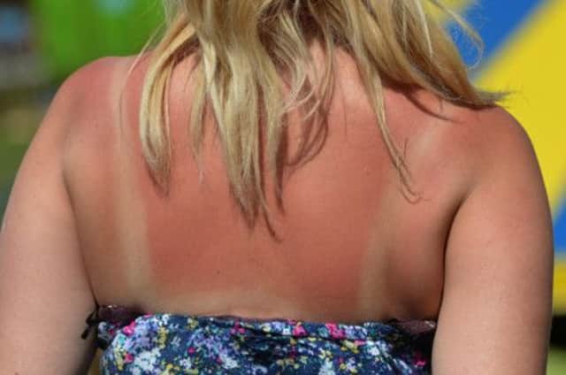 Sunburn is nature's warning to the sunworshipper to seek shade. Picture: PA