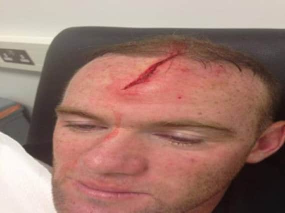 Wayne Rooney's head injury. Picture: Contributed