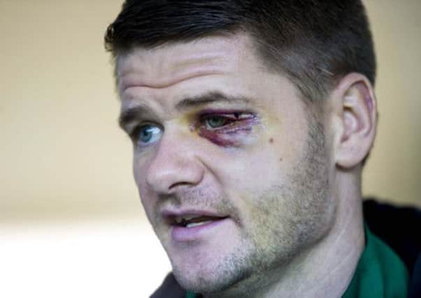 Hibernian defender Michael Nelson picked up the inury against Celtic. Picture: SNS