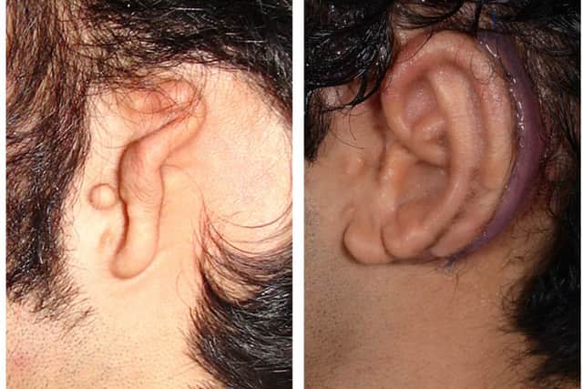 Shirazi's ear before and after surgery