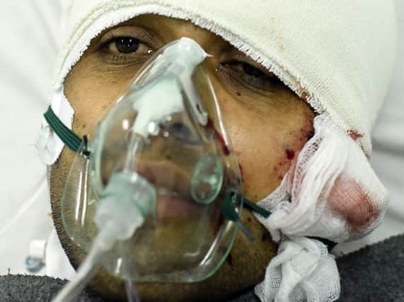 An Afghan man injured in the high school explosion receives hospital treatment. Picture: AFP/Getty Images