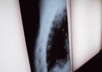 The Scots group will provide collagen powder for use in the manufacture of bone grafting products. Picture: TSPL