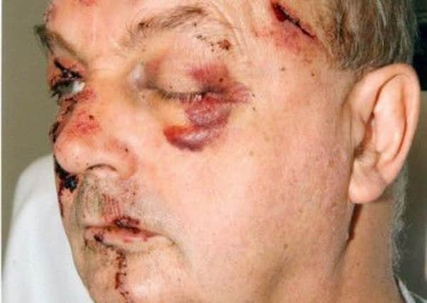Leslie Cumming's battered and scarred face after the brutal attack by hitman Robert Graham. Picture: PA