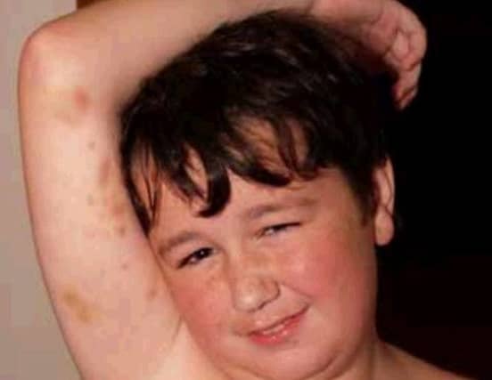 Beth Morrison's son Calum sustained bruising after being restrained by a teacher in 2010. Picture: Contributed