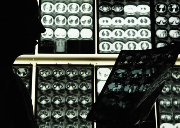 A doctor studies X-rays of lung cancer patients. The risk of lung cancer is increased twenty-fold in smokers. Picture: Rob McDougall