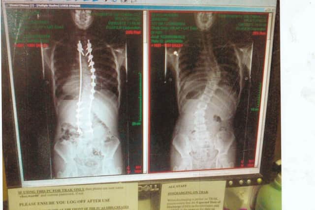 Xray image of Imogene's spine.