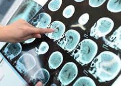 Brain scans of volunteers have helped to understand how intelligence can combat effects of dementia