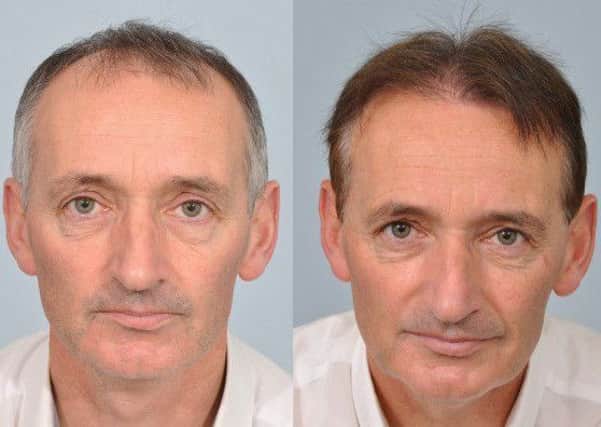 Pat Nevin underwent a hair transplant after being told his TV work would dry up. Picture: HRBR Hair Restoration