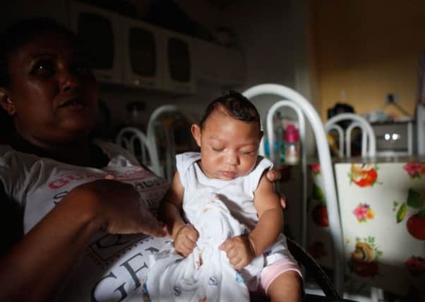A Brazilian baby suffering from microcephaly, which has been linked to the mosquito-borne Zika virus. Picture: Getty