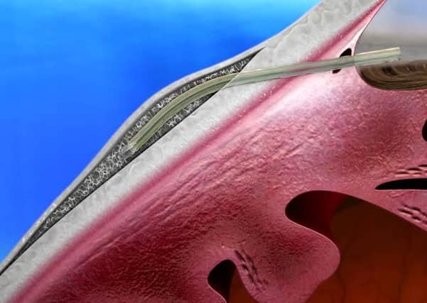 The XEN Gel Implant.
