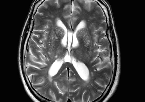 One of the MRI brain scans used in the Aberdeen findings