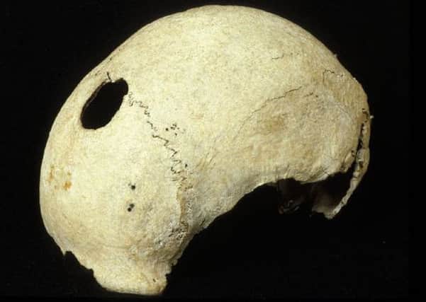 Culloden Battle skull