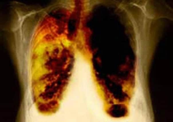 A person dies of lung disease in the UK every five minutes. Picture: PA
