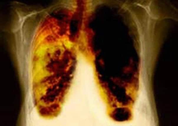 A person dies of lung disease in the UK every five minutes. Picture: PA