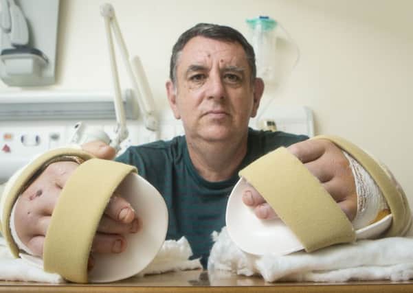 Chris King, Britain's first double hand transplant patient. Picture: Danny Lawson/PA Wire
