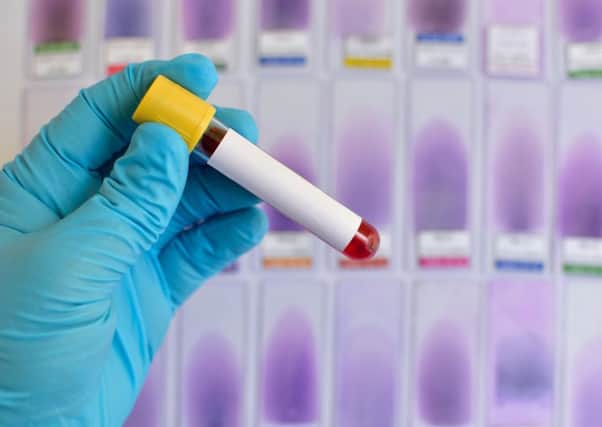 Hepatitis C can lead to serious liver damage if left untreated. Picture: Getty