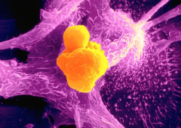 Cancerous tumour.