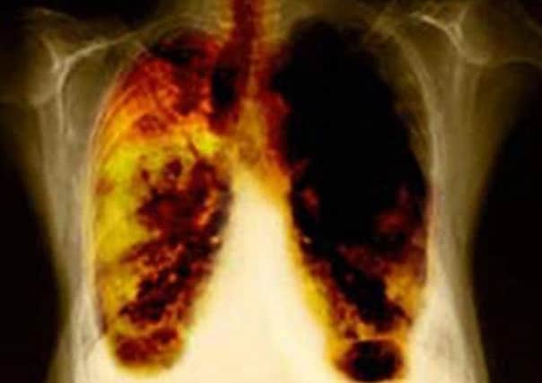 The new drug, nivolumab will lengthen the lives of patients battling lung cancer. Picture: PA