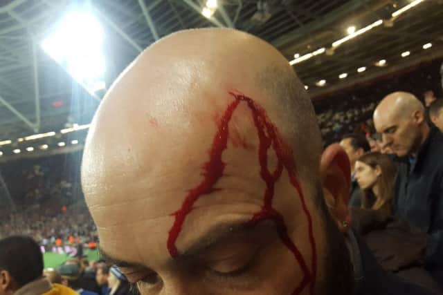 Chelsea supporter Steve Cutting with an injury to his head at the EFL Cup match against West Ham. Picture: @Gate8_CFC/Twitter/PA Wire