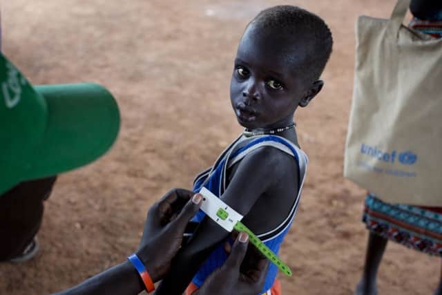 A boy has his arm measured to see if he is suffering from malnutrition in South Sudan. (Kate Holt/UNICEF via AP)
