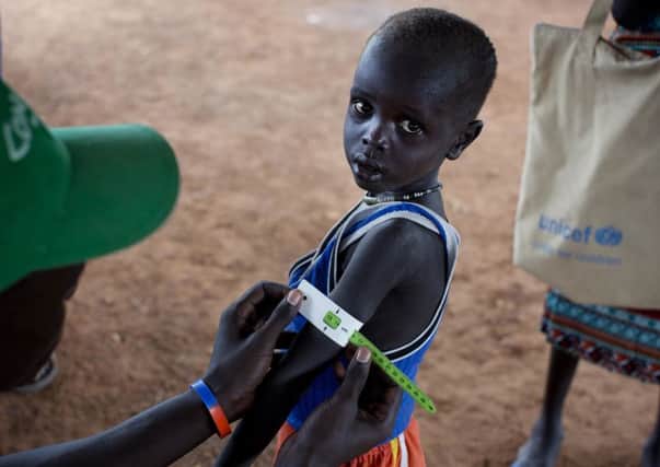 A boy has his arm measured to see if he is suffering from malnutrition in South Sudan. (Kate Holt/UNICEF via AP)