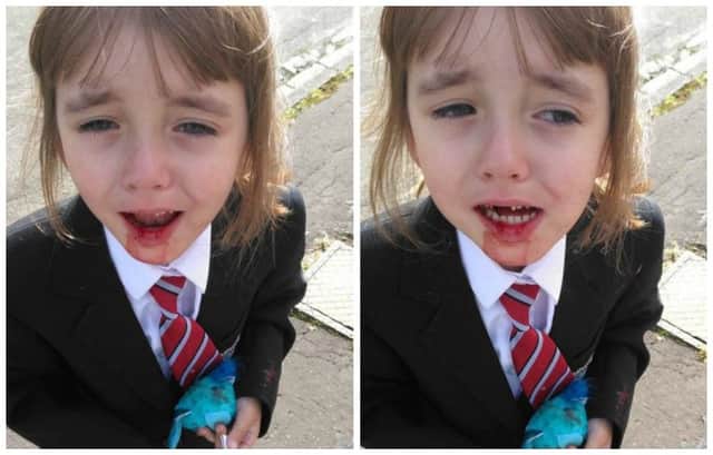 Victoria Rose Alton, 4, after she fell from a bus on her first day of school. Picture: SWNS