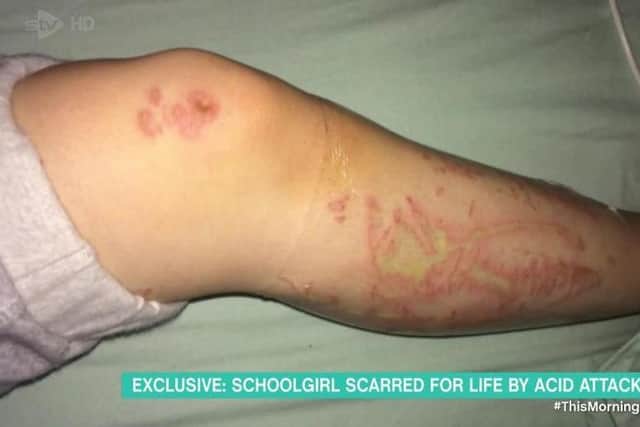 Molly suffered burns to her legs and permanent scarring after the incident. Picture: ITV