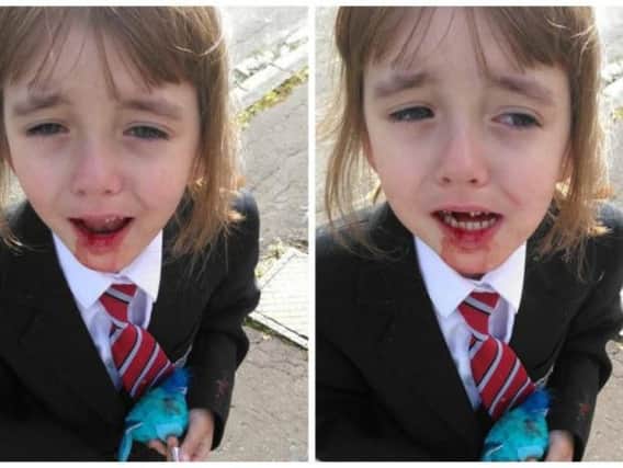 Victoria Rose Alton, four, with the injury her mother said happened as she got off the bus. Picture: SWNS