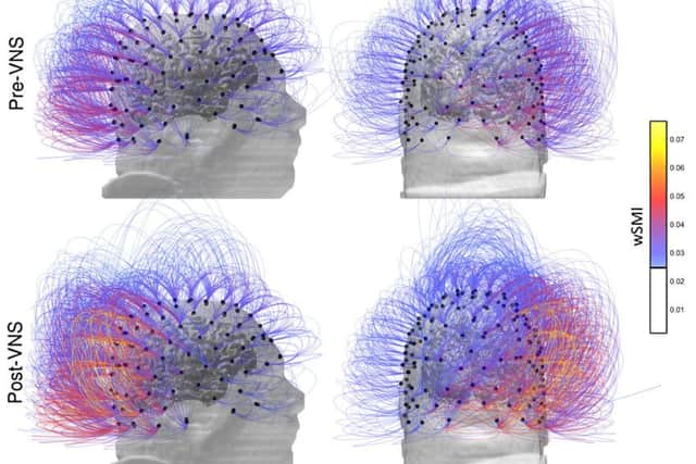 This image provided by the CNRS Marc Jeannerod Institute of Cognitive Science in Lyon, France, shows brain activity in a patient before, top row, and after vagus nerve stimulation.  (CNRS Marc Jeannerod Institute of Cognitive Science, Lyon, France via AP)