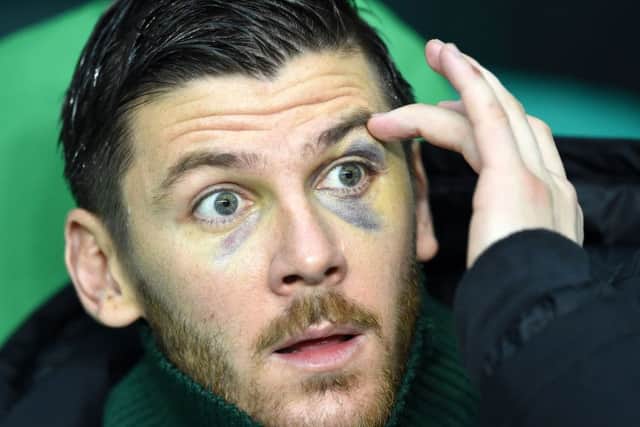 Celtic goalkeeper Lukasz Zaluska shows his black eye after the incident in Ashton Lane. Picture: SNS