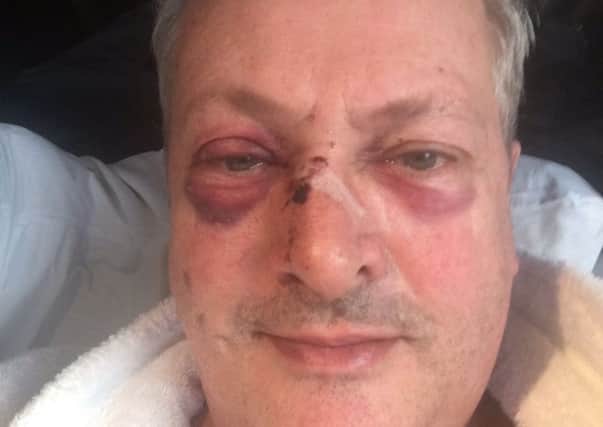 Nick Nairn tweeted an image of his injuries following the assault. Picture: Twitter/@NickNairn