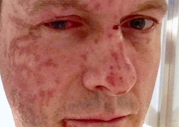 Burn injuries on the face and right eye of journalist Russell Findlay, days after the attack