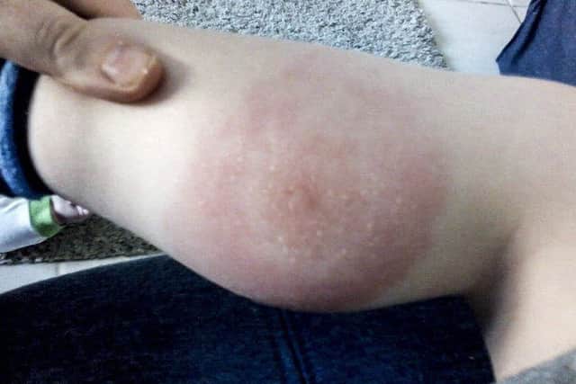 Image of the tick bite on Patrick's leg
. Picture: SWNS