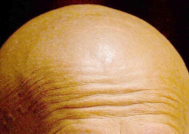 Researchers from the University of Manchester have found that baldness could be beaten by an experimental drug. Picture: PA Wire