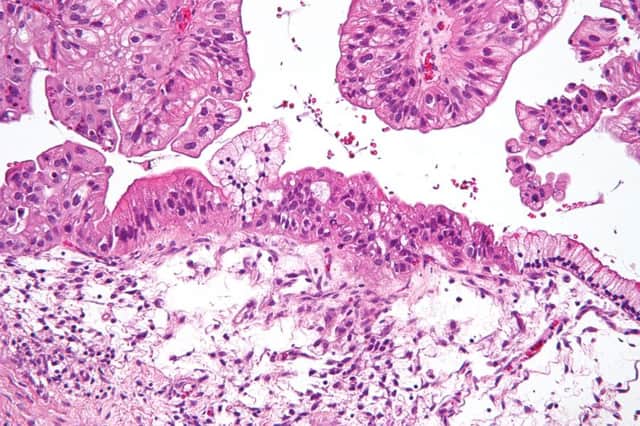 A close-up of ovarian cancer