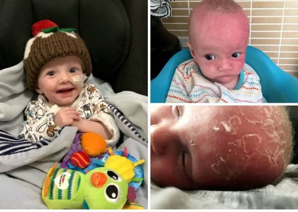 Freddie Mason-Perkins was born with Trichothiodystrophy (TTD) which means that if the 19-month-old is exposed to sunlight his skin will burn. Picture: SWNS