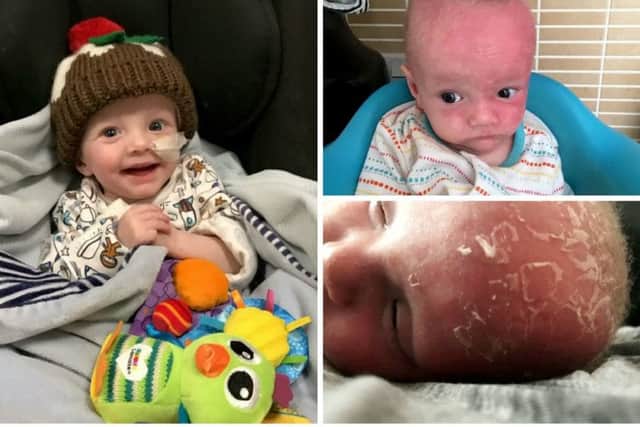 Freddie Mason-Perkins was born with Trichothiodystrophy (TTD) which means that if the 19-month-old is exposed to sunlight his skin will burn. Picture: SWNS