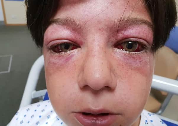 Tyler Broome, 11 from Nottingham, showing his bulging red eyes and spots around them known as G-measles, or Geasles after being spun on a roundabout as fast speed using the wheel of a motorcycle. Picture: SWNS
