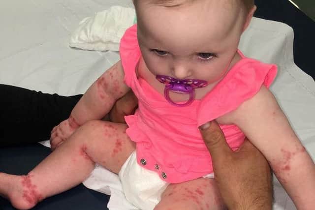 The effects of the foot and mouth disease on five-month-old Milla MacIntyre while on holiday. Picture: SWNS