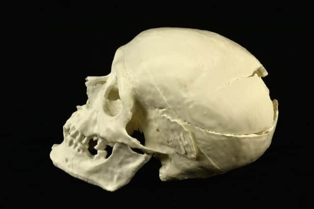 A 3D print of Solomon's skull which clearly shows the injuries sustained during his fatal attack in Fife around 1,500 years ago. PIC: Contributed.